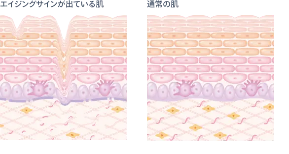 エイジングサインが出ている肌と通常の肌を比較したイメージ図